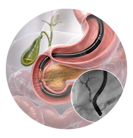 Diagnostic ERCP : Common Bile Duct Stone Detection
